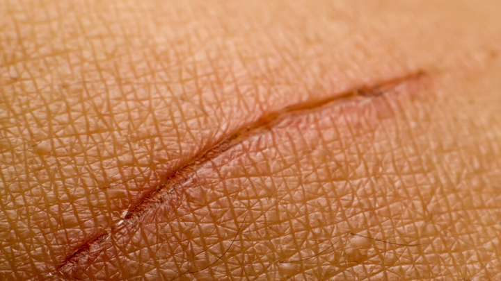 Skin Riping Breakthrough new formula will heal skin tears and rips faster - Starts ...
