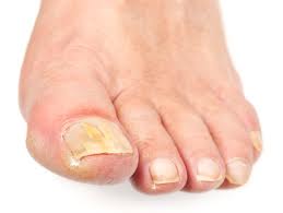 toenail fungus