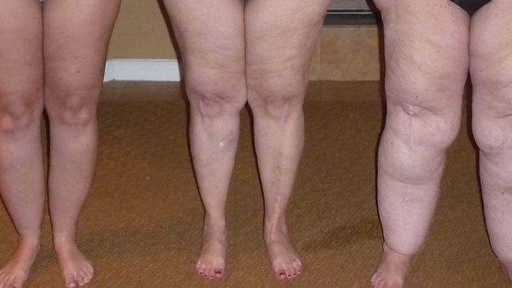 Your knees and feet have some weighty issues [Dieting After Sixty]