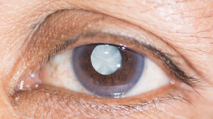 Sight is truly a gift – a personal experience of cataract surgery