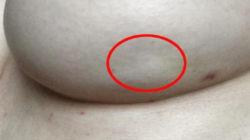 You can see the slight dimple circled in red, while the bruise and needle mark from the biopsy is to the right.