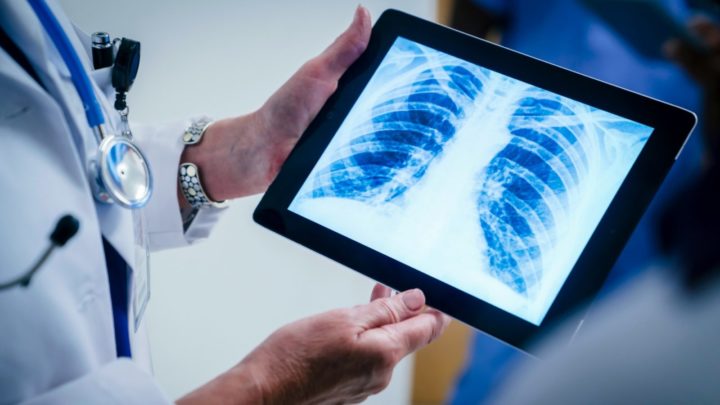 Early detection of lung cancer gives people the best chance of treating the disease. Source: Getty