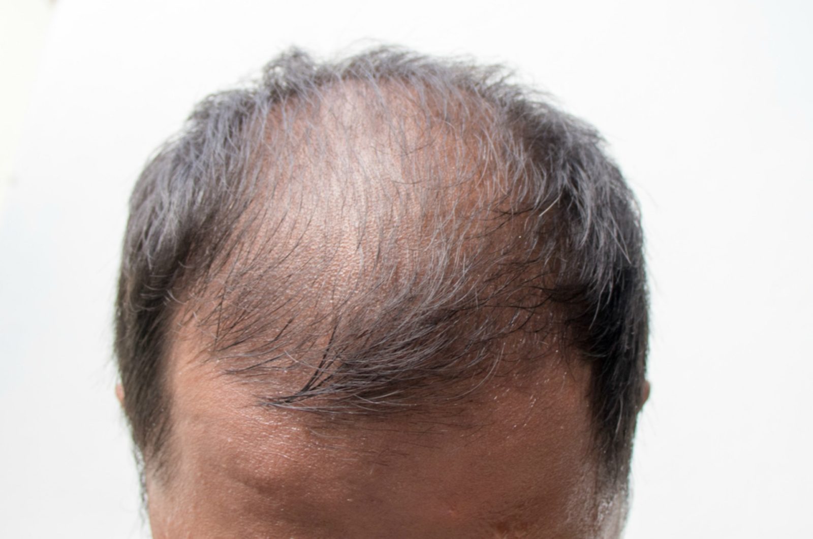 An elderly man with pattern baldness.