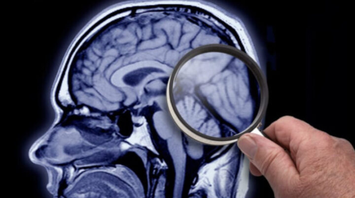 A "game-changing" new method for improving dementia detection using artificial intelligence (AI) could pick up thousands of undiagnosed people. Source: Getty Images. 