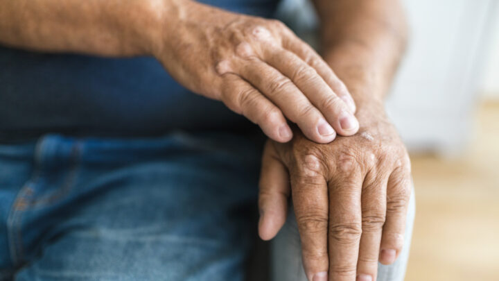 Discover the cutting-edge study that's changing the game for those living with Rheumatoid Arthritis. Source: Getty Images. 